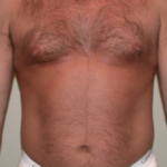 VASER Hi Def Liposuction Before & After Patient #6793