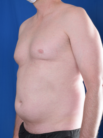VASER Hi Def Liposuction Before & After Patient #6900