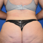 Standard Liposuction Before & After Patient #6905