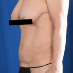 Tummy Tuck Before & After Patient #6910
