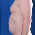 VASER Hi Def Liposuction Before & After Patient #6900