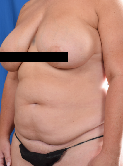 Tummy Tuck Before & After Patient #6919