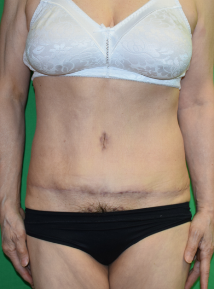 Tummy Tuck Before & After Patient #6910