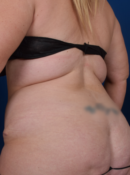 Standard Liposuction Before & After Patient #6905