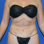 VASER Hi Def Liposuction Before & After Patient #6936
