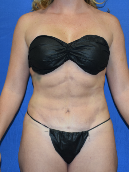 VASER Hi Def Liposuction Before & After Patient #6936