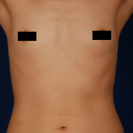 VASER Hi Def Liposuction Before & After Patient #6863