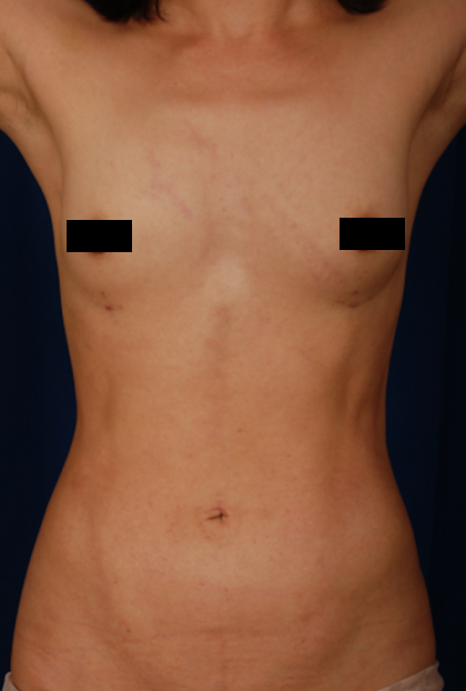 VASER Hi Def Liposuction Before & After Patient #6863