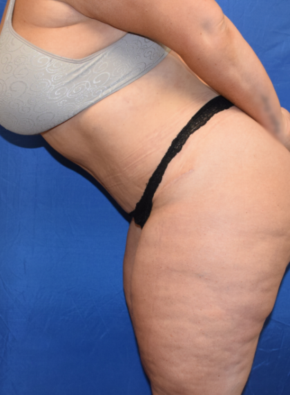 Tummy Tuck Before & After Patient #6919
