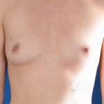 Breast Augmentation Before & After Patient #7053