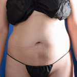 Standard Liposuction Before & After Patient #7067