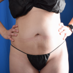 Standard Liposuction Before & After Patient #7067