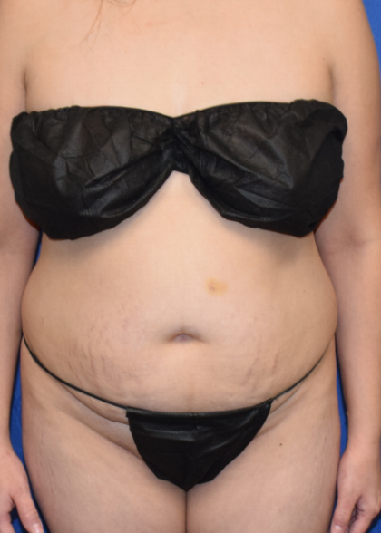 Patient #7072 Tummy Tuck Before and After Photos Denver - Plastic