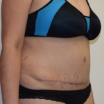 Tummy Tuck Before & After Patient #7072