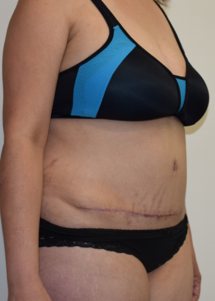 Tummy Tuck Before & After Patient #7072