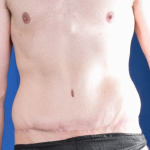 Tummy Tuck Before & After Patient #7078