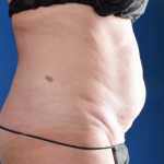 Tummy Tuck Before & After Patient #7086