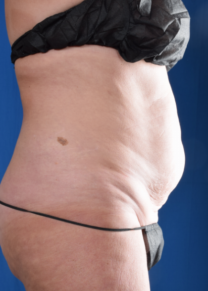 Tummy Tuck Before & After Patient #7086