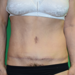 Tummy Tuck Before & After Patient #7091