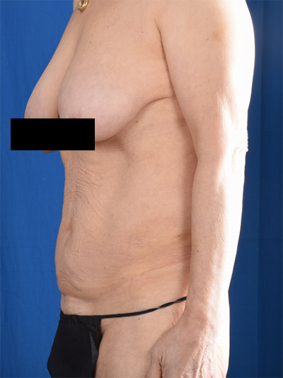Tummy Tuck Before & After Patient #7091