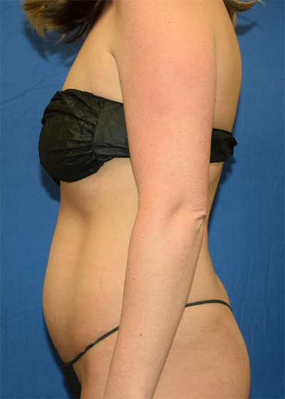 Tummy Tuck Before & After Patient #7098