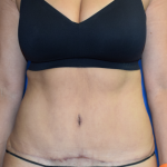 Tummy Tuck Before & After Patient #7105