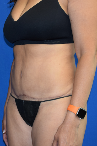 Tummy Tuck Before & After Patient #7105