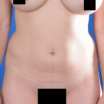Standard Liposuction Before & After Patient #7182