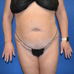 Tummy Tuck Before & After Patient #7189