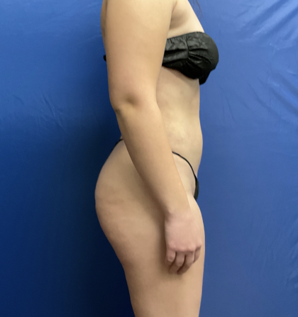 Standard Liposuction Before & After Patient #7171