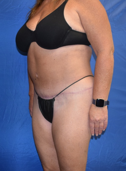 Tummy Tuck Before & After Patient #7189