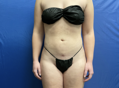 Standard Liposuction Before & After Patient #7171