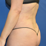 Standard Liposuction Before & After Patient #7134