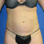 Standard Liposuction Before & After Patient #7134