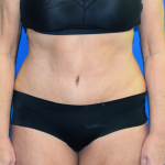 Tummy Tuck Before & After Patient #7141