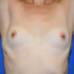 Breast Augmentation Before & After Patient #7157