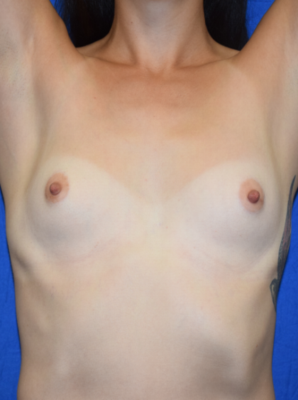Breast Augmentation Before & After Patient #7157