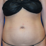 Tummy Tuck Before & After Patient #7198