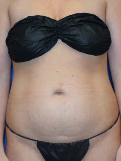Tummy Tuck Before & After Patient #7198