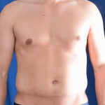 VASER Hi Def Liposuction Before & After Patient #7145