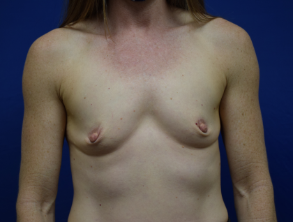 Breast Augmentation Before & After Patient #7148
