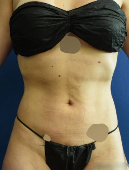 VASER Hi Def Liposuction Before & After Patient #7379