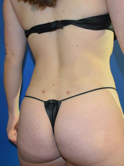 VASER Hi Def Liposuction Before & After Patient #7379