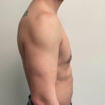 Gynecomastia Before & After Patient #7377