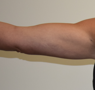Arms Liposuction Before & After Patient #7359