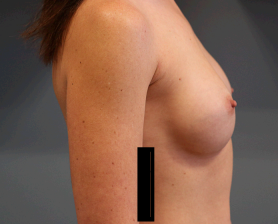 Breast Augmentation Before & After Patient #7264