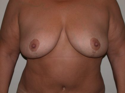 Breast Lift/Reduction Before & After Patient #7273