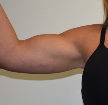 Arms Liposuction Before & After Patient #7359