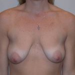 Breast Lift/Reduction Before & After Patient #7297