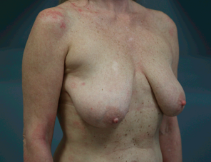 Breast Lift/Reduction Before & After Patient #7298